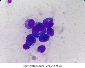 Abnormal cell with deep blue cytoplasm, Vacuolization,
Predominant nucleoli in Body Exam