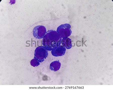 Abnormal cell with deep blue cytoplasm, Vacuolization,
Predominant nucleoli in Body Exam