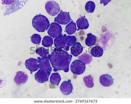Abnormal cell with deep blue cytoplasm, Vacuolization,
Predominant nucleoli in Body Exam