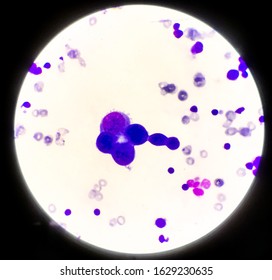 Abnormal Cells Pleural Fluid Wright Staining Stock Photo (Edit Now ...