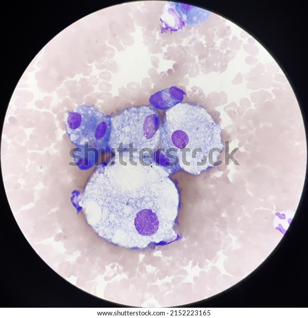 Abnormal cells\
with vacuolization in body\
fluid.