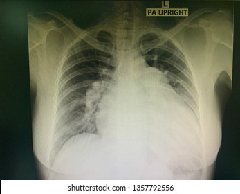 Abnormal Chest X-ray , Cardiomegaly , Pulmonary Hypertension , Right Sided Heart Failure