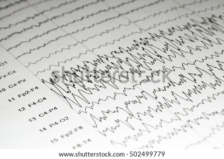 Abnormal EEG on brain wave background,Epileptiform discharge