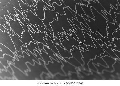 Abnormal EEG Report In Hospital,EEG Wave Background