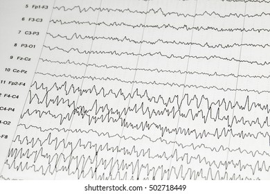 Abnormal Eegbrain Wave On Electroencephalogram Eeg Stock Photo ...