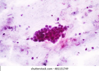 Abnormal Glandular Epithelial Cells View In Microscopy.Pap Smear Slide Cytology.Medical Background.