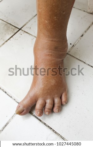 Abnormal left foot of women. Hallux valgus foot. 