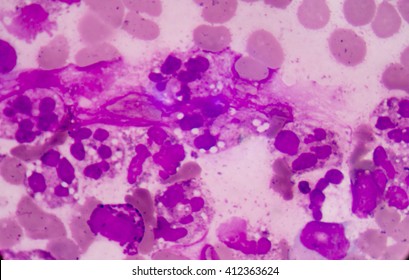 Abnormal neutrophil in pleural fluid smear.Sepsis or septicaemia is a life-threatening illness. Presence of numerous bacteria in the blood, causes the body to respond in organ dysfunction. 