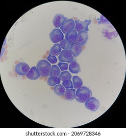 Abnormal Plasma Cells In Body Fluid.