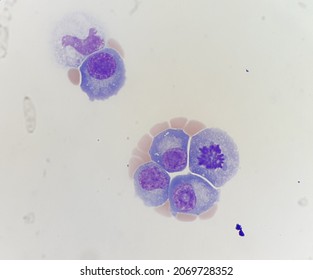 Abnormal Plasma Cells In Body Fluid.