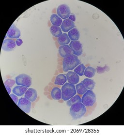 Abnormal Plasma Cells In Body Fluid.