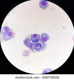 Abnormal Plasma Cells In Body Fluid.