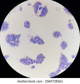 Abnormal Plasma Cells In Body Fluid.