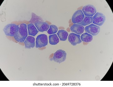 Abnormal Plasma Cells In Body Fluid.