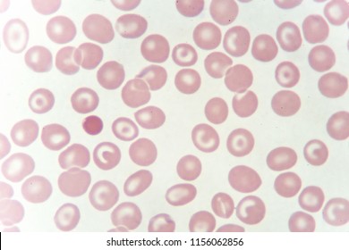 Abnormal Red Blood Cells Anemia Patient Stock Photo 1156062856 ...