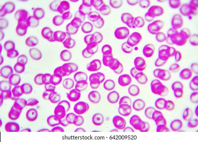 Abnormal Red Blood Cells In Anemia Patient