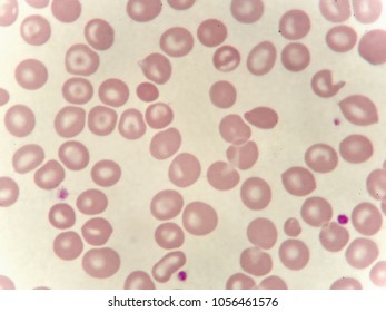 Abnormal Red Blood Cells Thalassemia Patient Stock Photo 1056461576 ...