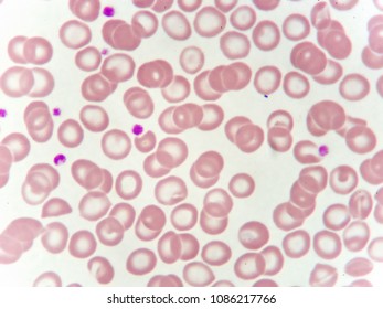 Thalassemia Blood Cells