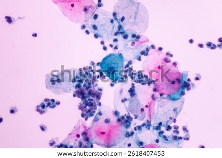Abnormal squamous epithelial cells on white background view in microscopy.Atypical epithelial cells criteria for pap smear slide cytology.Medical background.