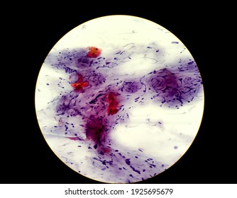 Abnormal Squamous Epithelial Cells View In Microscopy.HPV Criteria For Pap Smear Slide Cytology.Koilocyte Cells.Medical Background.