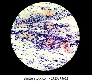 Abnormal Squamous Epithelial Cells View In Microscopy.HPV Criteria For Pap Smear Slide Cytology.Koilocyte Cells.Medical Background.