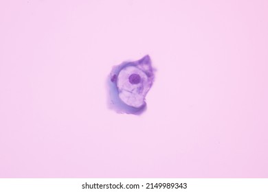 Abnormal Squamous Epithelial Cells View In Microscopy.HPV Criteria For Pap Smear Slide Cytology.Koilocyte Cells.Human Cell Medical Concept Background.