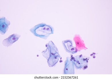 Abnormal Squamous Epithelial Cells View In Microscopy.HPV Criteria For Pap Smear Slide Cytology.Koilocyte Cells.Human Cell Medical Concept Background.