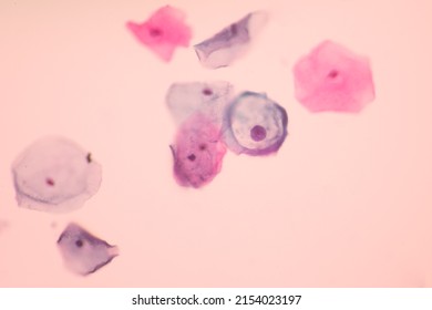 Abnormal Squamous Epithelial Cells View In Microscopy.HPV Criteria For Pap Smear Slide Cytology.Koilocyte Cells.Human Cell Medical Concept Background.