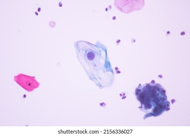 Abnormal Squamous Epithelial Cells View In Microscopy.HPV Criteria For Pap Smear Slide Cytology.Koilocyte Cells.Human Cell Medical Concept Background.