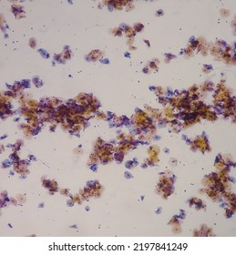 Abnormal Squamous Epithelial Cells View In Microscopy.HPV Criteria For Pap Smear Slide Cytology. Medical Concept.