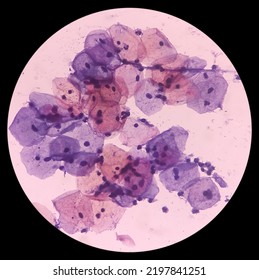 Abnormal Squamous Epithelial Cells View In Microscopy.HPV Criteria For Pap Smear Slide Cytology. Medical Concept.