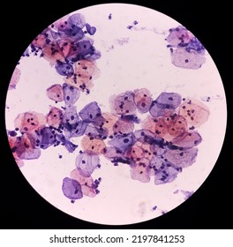 Abnormal Squamous Epithelial Cells View In Microscopy.HPV Criteria For Pap Smear Slide Cytology. Medical Concept.