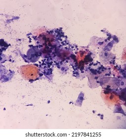 Abnormal Squamous Epithelial Cells View In Microscopy.HPV Criteria For Pap Smear Slide Cytology. Medical Concept.