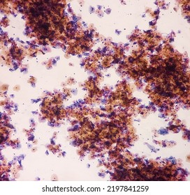 Abnormal Squamous Epithelial Cells View In Microscopy.HPV Criteria For Pap Smear Slide Cytology. Medical Concept.