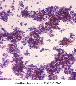 Abnormal Squamous Epithelial Cells View In Microscopy.HPV Criteria For Pap Smear Slide Cytology. Medical Concept.