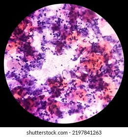 Abnormal Squamous Epithelial Cells View In Microscopy.HPV Criteria For Pap Smear Slide Cytology. Medical Concept.