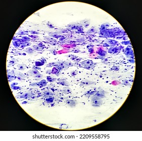 Abnormal Squamous Epithelial Cells View In Microscopy.HPV Criteria For Pap Smear Slide Cytology. Medical Concept