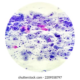 Abnormal Squamous Epithelial Cells View In Microscopy.HPV Criteria For Pap Smear Slide Cytology. Medical Concept