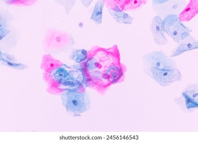 Abnormal squamous epithelial cells view in microscopy.HPV criteria for pap smear slide cytology and pathology.Koilocyte cells on white background.Human cell medical concept.