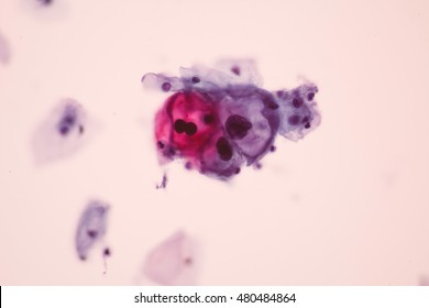 Abnormal Squamous Epithelial Cells View In Microscopy.HPV Criteria For Pap Smear Slide Cytology.Koilocyte Cells.Medical Background.