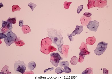 Abnormal Squamous Epithelial Cells View In Microscopy.Pap Smear Slide Cytology.Medical Background.