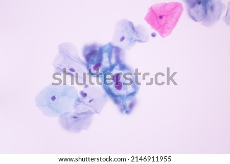 Abnormal squamous epithelial cells view in microscopy.HPV criteria for pap smear slide cytology and pathology.Koilocyte cells on white background.Human cell medical concept.