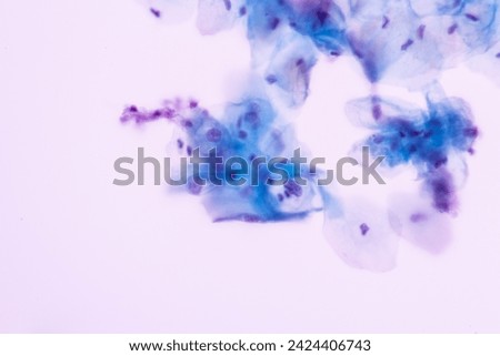 Abnormal squamous epithelial cells view in microscopy.Humanpapilloma virus (HPV) criteria for pap smear slide cytology.Koilocyte cells.Human cell medical concept background.