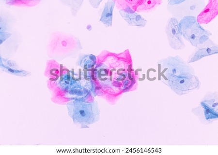 Abnormal squamous epithelial cells view in microscopy.HPV criteria for pap smear slide cytology and pathology.Koilocyte cells on white background.Human cell medical concept.