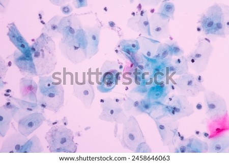 Abnormal squamous epithelial cells view in microscopy.HPV criteria for pap smear slide cytology and pathology.Koilocyte cells on white background.Human cell medical concept.