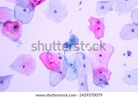 Abnormal squamous epithelial cells view in microscopy.Low grade SIL criteria for pap smear slide cytology and pathology.Human cell medical concept.