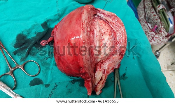 Abnormal Uterus After Total Abdominal Hysterectomy Stock Photo (Edit