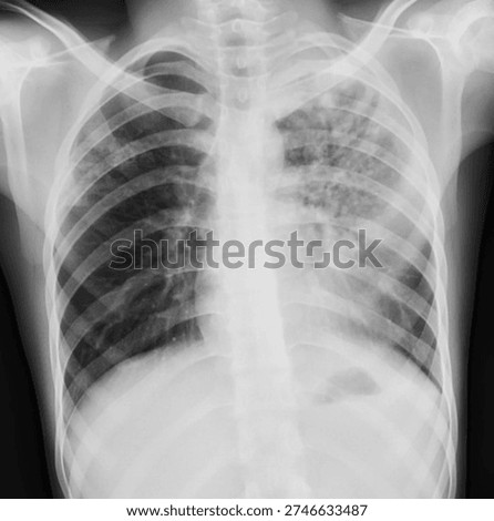 abnormal x-ray image of the lungs in the human body