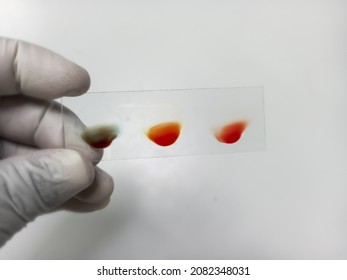 ABO and Rh typing blood grouping by slide test technique. "O" Negative group white background