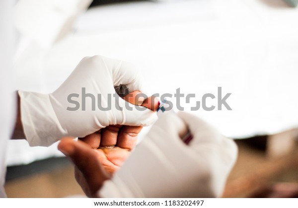 above view of bleeding finger after puncture for\
free hiv test in african\
hospital